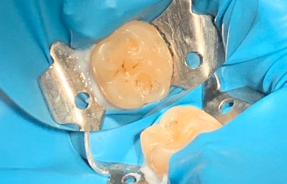 Замена дефектной пломбы 36 зуба