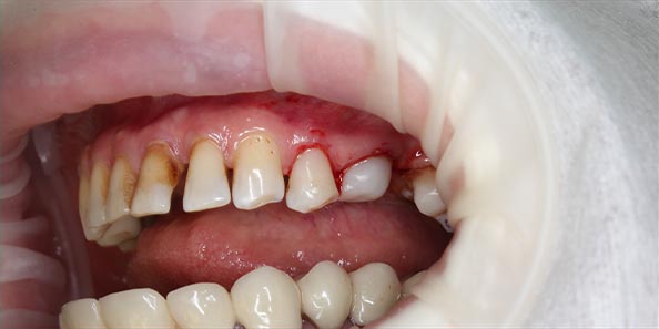 Лечение кариеса боковых групп зубов