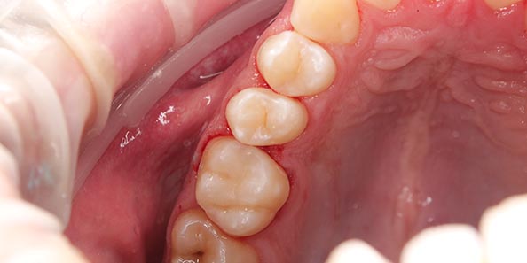 Лечение кариеса жевательных зубов