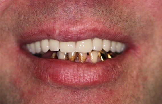 Имплантация зубов по концепции все на 4