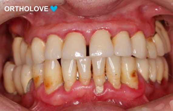 Восстановлении зубного ряда нижней и верхней челюсти на четырех имплантах