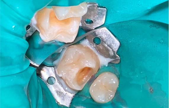 Лечение глубокого кариеса 16 зуба