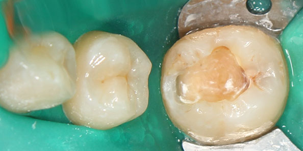 Лечение глубокого кариеса в области жевательного зуба