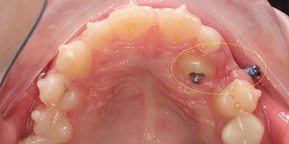Сложное перемещение зуба в процессе лечения на элайнерах Eurokappa