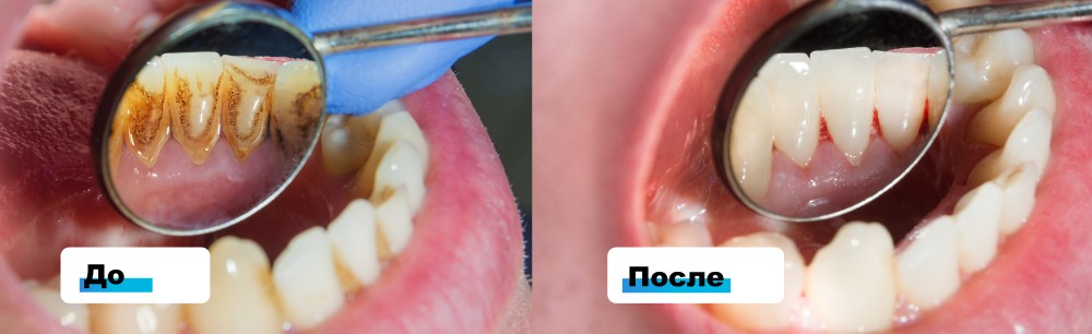 Чистка зубов в стоматологии