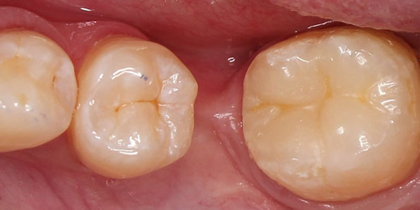Лечение глубокого кариеса в области жевательного зуба