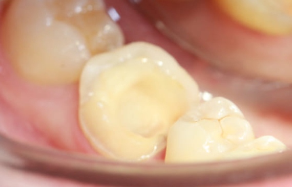 Эндодонтическое лечение каналов зуба
