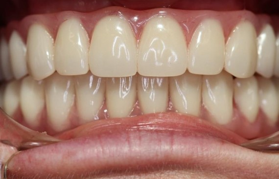 Восстановление утраченных зубов на нижней и верхней челюсти по методу все на 4