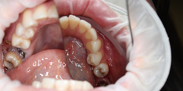Лечение глубокого кариеса и восстановление зуба