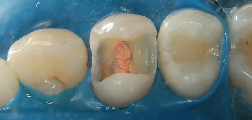 Лечение пульпита 24 зуба