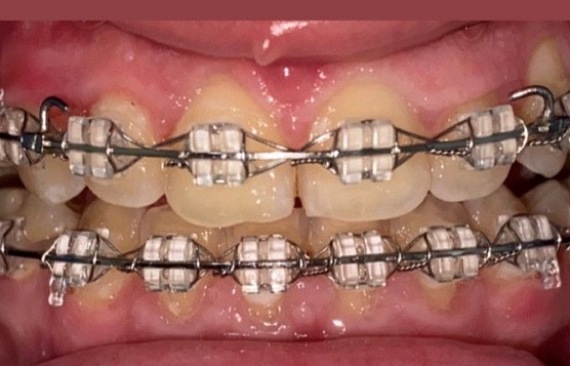 Ортодонтическое лечение открытого прикуса