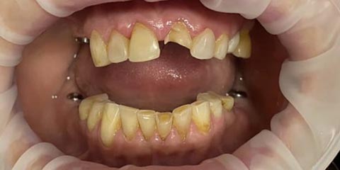 Экстренная установка импланта зуба и немедленное протезирование