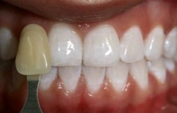 Реставрация передних зубов верхней и нижней челюсти