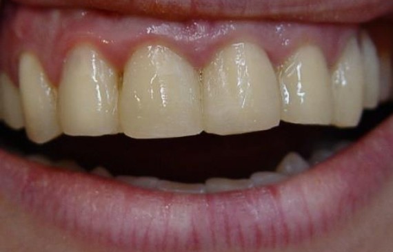 Эстетическая реставрация передних зубов верхней челюсти