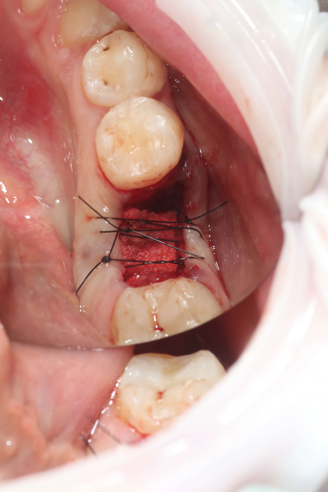 Удаление жевательного зуба