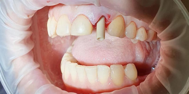 Одномоментная имплантация зуба