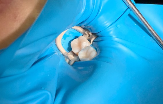 Восстановление окклюзионных поверхностей зубов композитным материалом