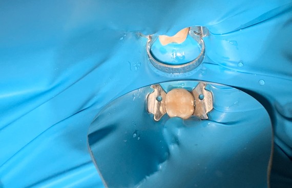 Восстановление жевательной поверхности композитным материалом 46 зуб