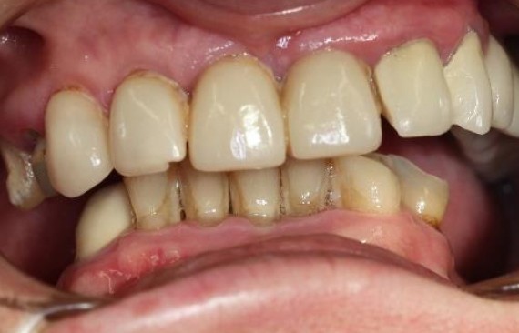 Восстановление утраченных зубов на нижней и верхней челюсти по методу все на 4