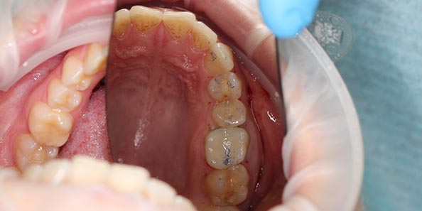 Лечение глубокого кариеса и восстановление анатомиеской формы зубов