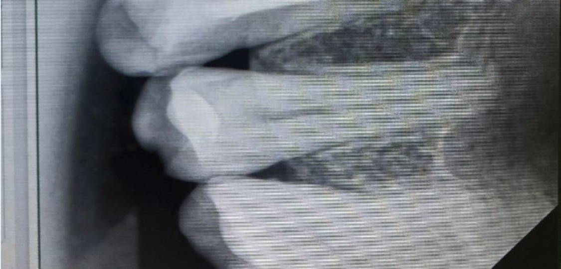 Эндодонтия двух канального зуба