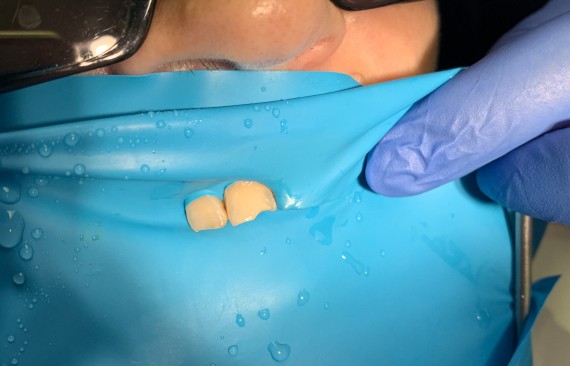 Восстановление угла коронковой части 11 зуба