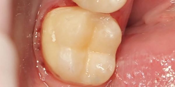 Лечение кариеса между дальними жевательными зубами