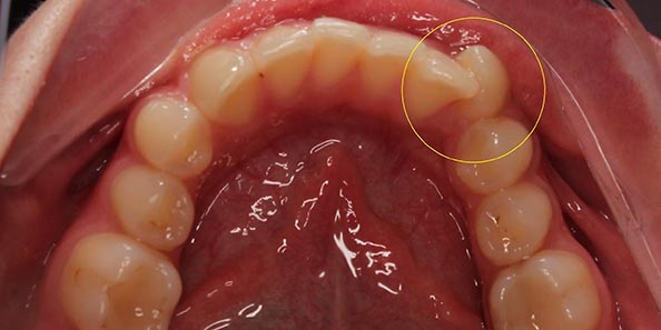 Перемещение зубов в анатомически и функционально правильное положение в процессе ортодонтического лечения