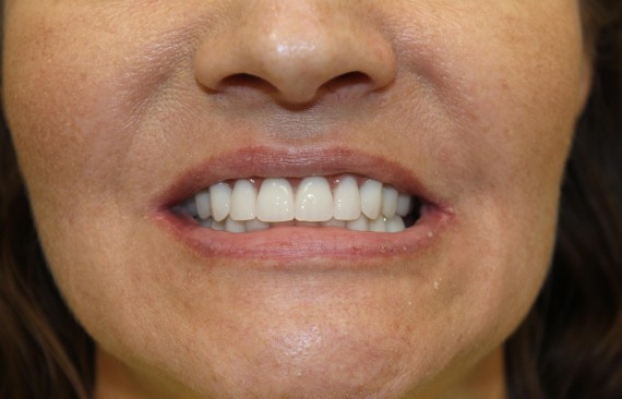 Восстановление утраченных зубов с помощью технологии all-on-4