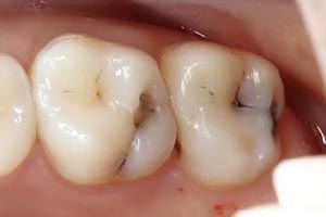 Лечение кариеса и восстановление зуба