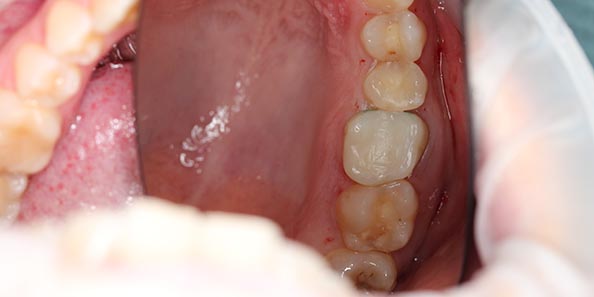Лечение глубокого кариеса и восстановление анатомиеской формы зубов