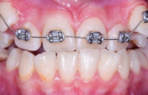 Установка брекет-систем для выравнивания зубов