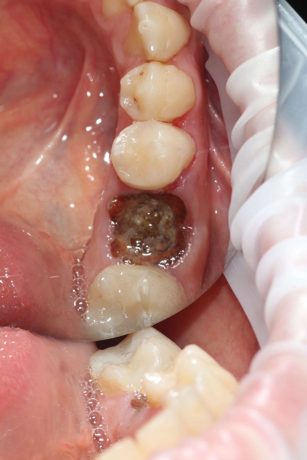 Удаление жевательного зуба