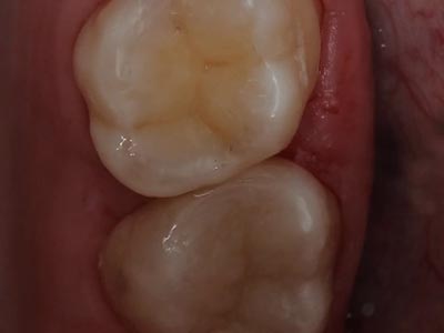 Лечение глубокого кариеса на жевательных зубах