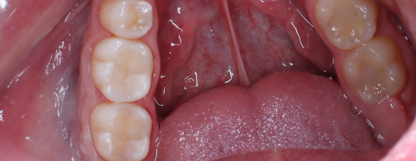 Лечение кариеса на жевательных зубах 35, 36, 37