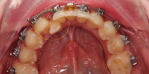 Наложение специальной тяги для восстановления функциональности зубного ряда