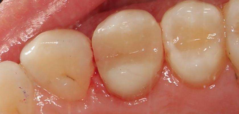 Лечение пульпита 24 зуба