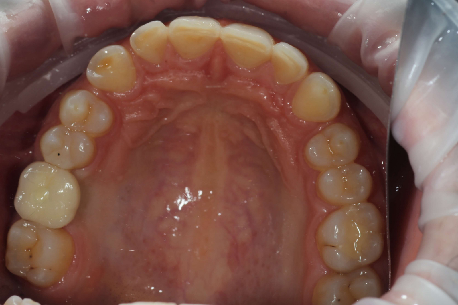 Протезирование на импланте жевательного зуба. коронка из диоксид циркония