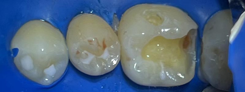 Лечение глубокого кариеса на жевательных зубах