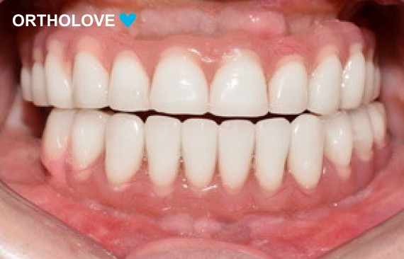 Восстановлении зубного ряда нижней и верхней челюсти на четырех имплантах