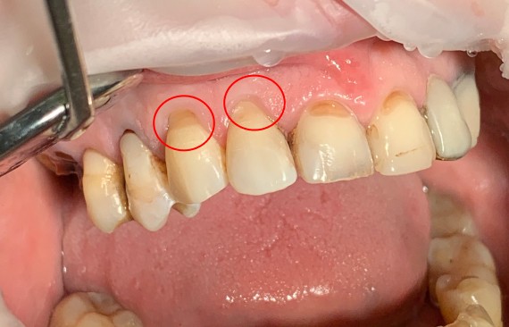Лечение кариеса на контактных поверхностях 13,12 зубов