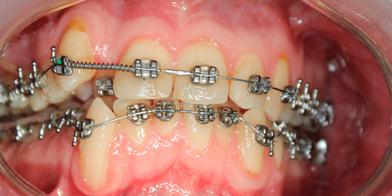 Установка самолигирующих брекетов с целью исправления скученности зубов