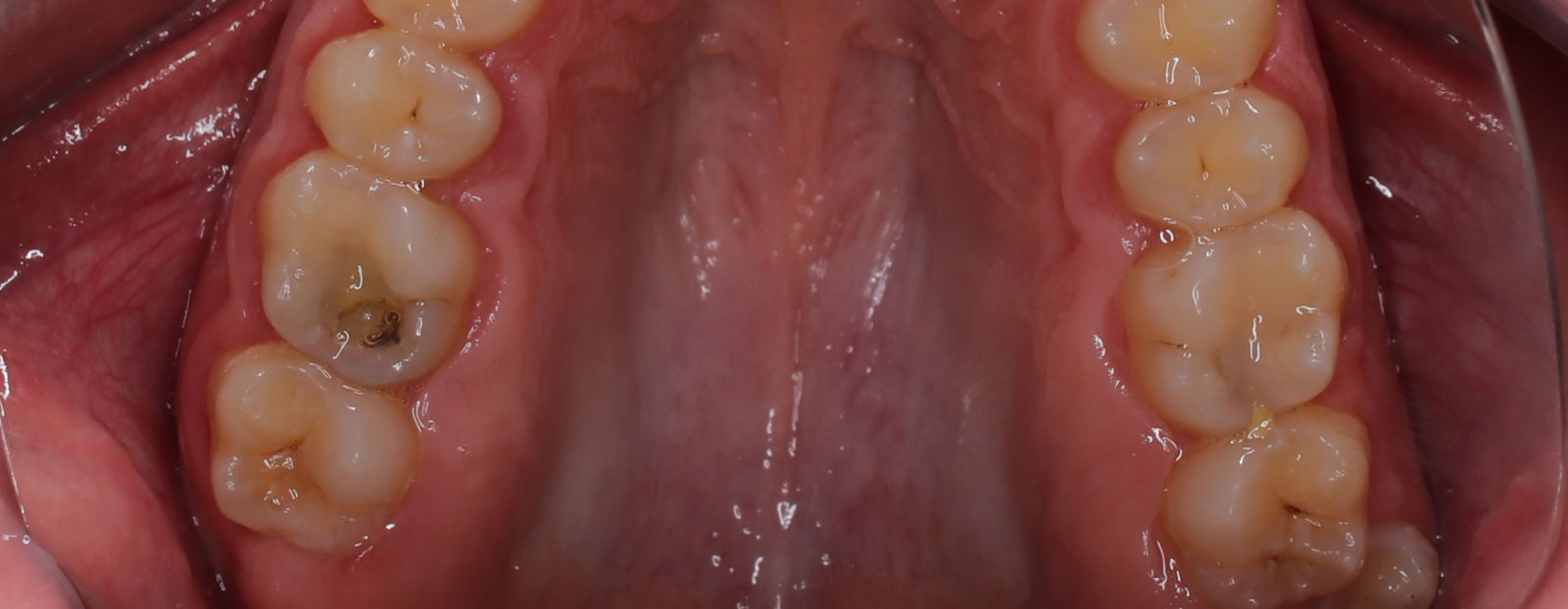 Лечение кариеса на жевательных зубах 35, 36, 37