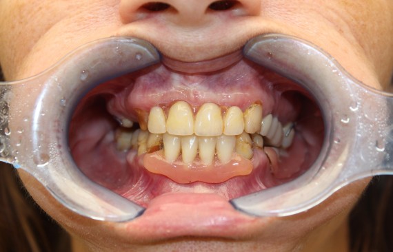 Восстановление утраченных зубов с помощью технологии all-on-4