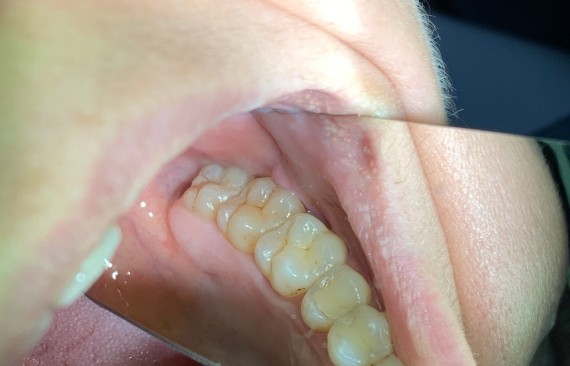 Лечение глубокого кариеса окклюзионной поверхности 28 зуба