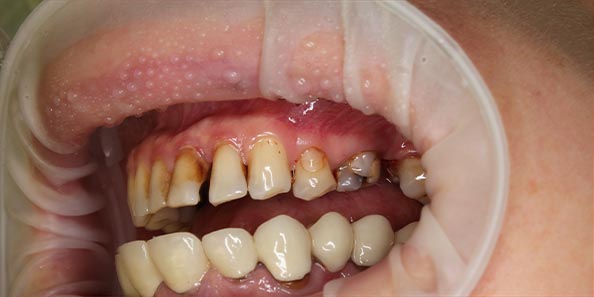 Лечение кариеса боковых групп зубов