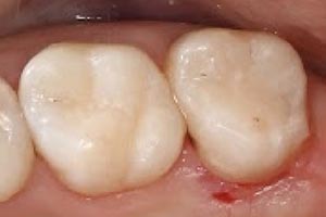 Лечение кариеса и восстановление зуба