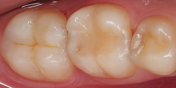 Лечение глубокого кариеса и восстановление анатомической формы зуба