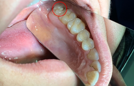 Лечение глубокого кариеса окклюзионной поверхности 28 зуба