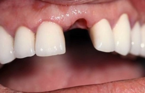 Восстановление зуба имплантатом